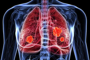 Best Lung Cancer Treatment in Pune | Lung Cancer Specialist